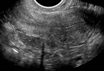 Endometrium przez dniowego cyklu w normalnym zakresie w przypadku odchyleń od niej