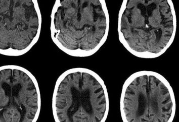 CT scan de la tête: la procédure de révision