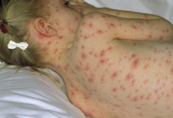 Lo que podría ser las consecuencias de la varicela en adultos?