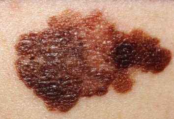 Come si fa a riconoscere un melanoma in una fase iniziale? Segni e sintomi del melanoma della pelle (foto)