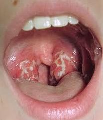 ¿De dónde viene aureus en la garganta. Los síntomas de la infección