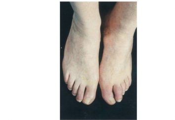 La gangrena de las piernas: Causas, síntomas y tratamiento