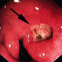 Causas, os sintomas da úlcera 12 úlcera duodenal, métodos de tratamento