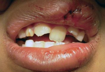 Dislocazione di denti: tipi, trattamento, le foto