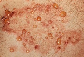 La dermatitis herpetiforme: causas, síntomas y métodos de tratamiento