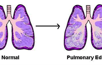 Przyczyny obrzęku płuc i prinitspy leczenia tego stanu patologicznego