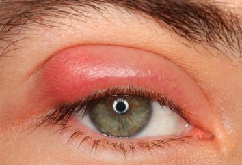 Geschwollene obere Augenlider: die zugrunde liegenden Ursachen und Methoden des Problems loszuwerden