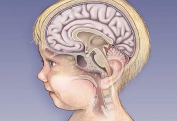 Jak poważne są skutki zapalenia opon mózgowych u dzieci?