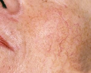La depilación láser de las arañas vasculares en la cara