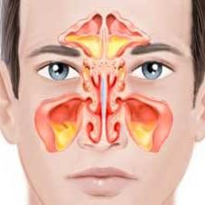 Doppelseitiges Sinusitis: Symptome und Behandlung