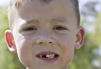 denti anneriti – cosa fare? denti anneriti in un bambino