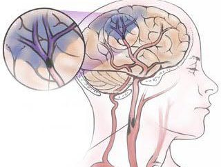 Los síntomas y el tratamiento del accidente cerebrovascular isquémico