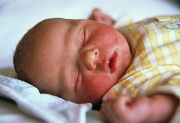Escrófula el bebé: causas, síntomas, tratamiento