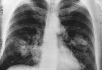 Rak płuc: Ile żyć? Powinienem wierzyć prognozy?