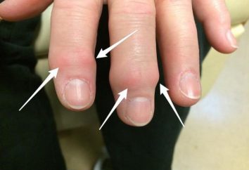 L'artrosi della mano: i sintomi, foto, il trattamento di rimedi popolari, dieta