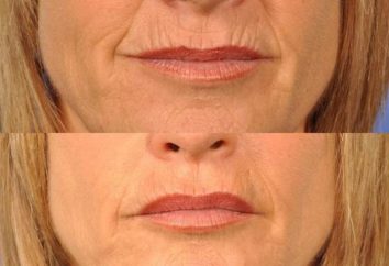 Come pulire le rughe sul labbro superiore: opinioni cosmetologi. Come rimuovere rughe sul labbro superiore nei rimedi popolari casa?