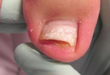 Peeling des ongles sur les orteils: les causes et les caractéristiques du traitement