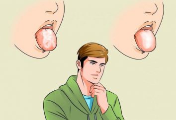 Weiße Zunge Beschichtung (auf der Wurzel): Ursachen