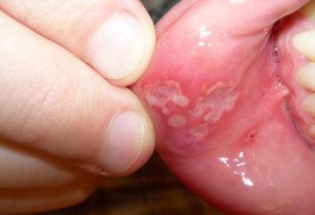 Objawy, przebieg i leczenie zapalenia jamy ustnej u dzieci w domu