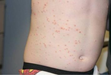 Enfermedades de la piel – moluscos contagiosos