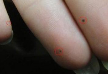 Moles an den Händen, die Finger: Der Wert