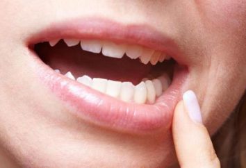 Come rimuovere il gonfiore dopo la rimozione dente del giudizio?