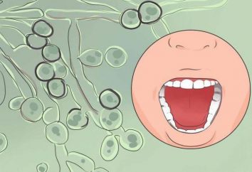 Kandydoza jamy ustnej: leczenie i zapobieganie