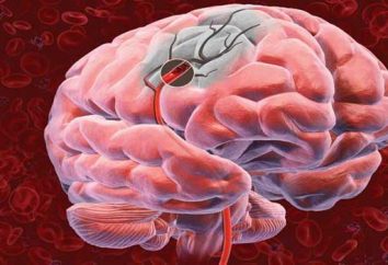Come identificare un disturbo della circolazione cerebrale: sintomi, trattamento