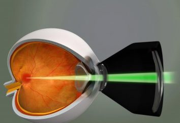 la coagulazione laser della retina
