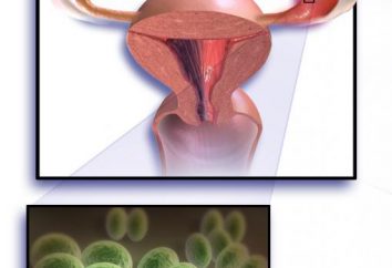 Salpingo – une inflammation des ovaires phanères