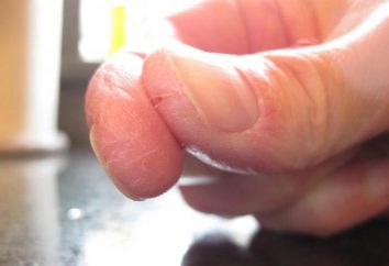 Los dedos se agrietan: causas y tratamiento
