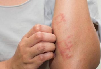 Tossico e dermatite allergica: cause, sintomi, il trattamento