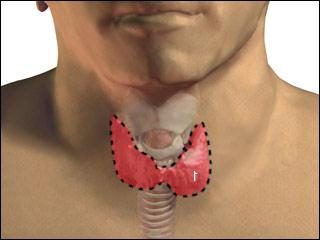 Ablation de la glande thyroïde: les effets de la chirurgie