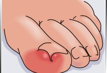 Warto wiedzieć: jak leczyć wrastanie paznokci w domu