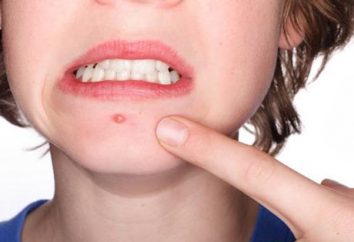 Wie die Rötung der Akne zu entfernen und das Auftreten von Hautausschlag verhindern