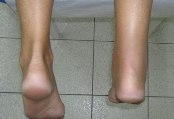 La hinchazón de la articulación del tobillo: causas y características de tratamiento