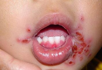 Comment traiter la stomatite chez un enfant?