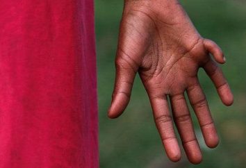 La anomalía del desarrollo de las extremidades: ¿qué hacer si un niño tiene seis dedos en sus manos o pies