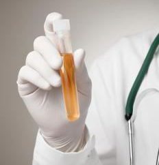 Aumento de oxalato na urina – o que significa isso?