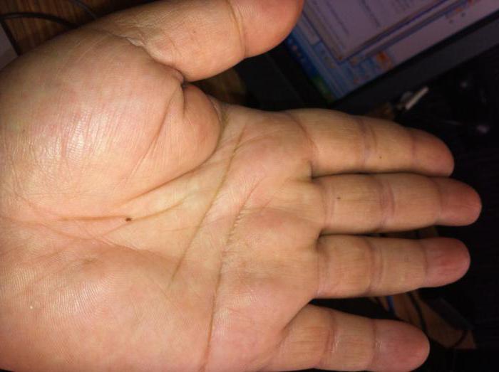 Significado de moles na palma da mão: ele diz quiromancia?