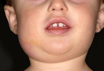 Die Symptome einer Mumps bei Kindern und Erwachsenen