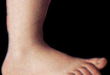 Espina en el talón – la lucha con el malestar de los remedios caseros