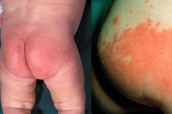dermatite da pannolino in un bambino: prevenzione e trattamento