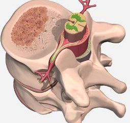 spinale emangioma – che cos'è? Come per il trattamento di un emangioma vertebrale