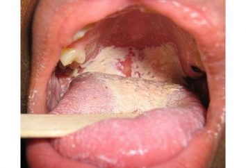 Zapalenie jamy ustnej kiełbasek: przyczyny początków, symptomatologii i sposobów eliminacji choroby