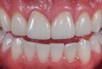 denti in ceramica: panoramica, caratteristiche, e recensioni di fabbricazione
