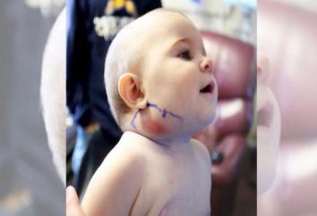 Vergrößerte Lymphknoten am Hals des Kindes. Ursachen und Behandlung