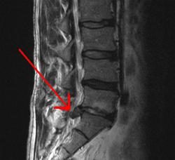 Disco protrusione della colonna lombare. Come per il trattamento di protrusione discale vertebrale?