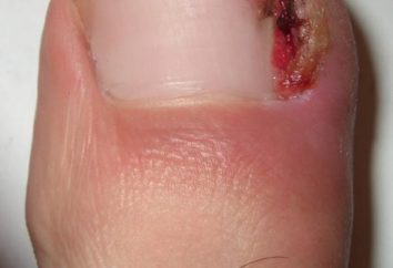 ¿Por qué crece la uña en el dedo gordo del pie?