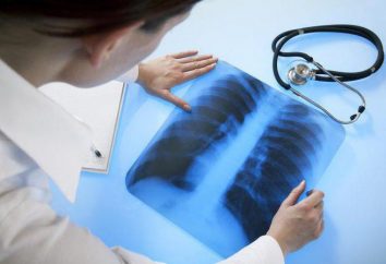 Tos en la tuberculosis: características y síntomas